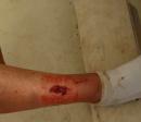 Leg wound